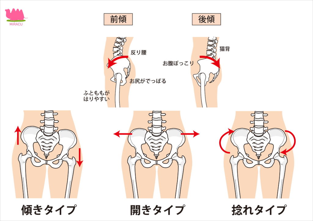 骨盤が歪んだまま過ごしていませんか 簡単セルフチェック みらく鍼灸整骨院